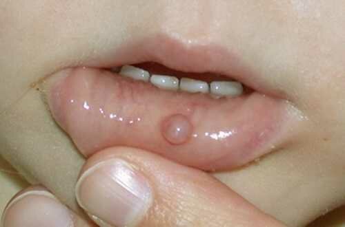 Киста слизистой оболочки полости рта